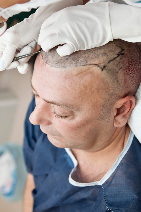 Advanced Hair Transplant