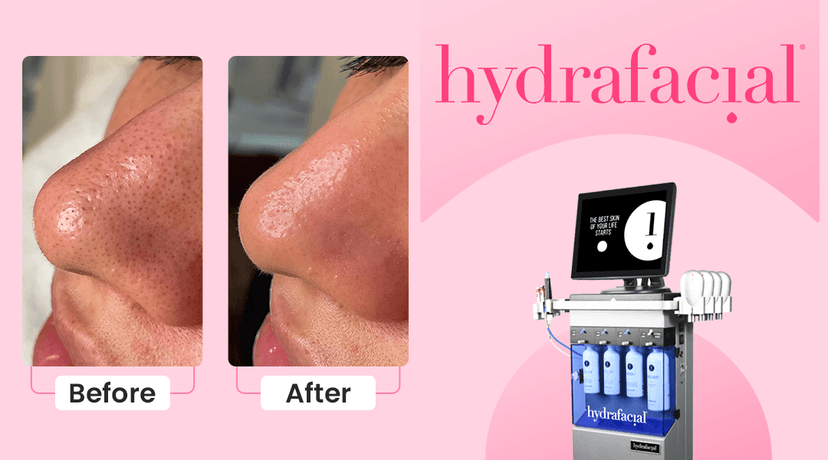 HydraFacial Before and After – Effective Guide | Dermapuritys